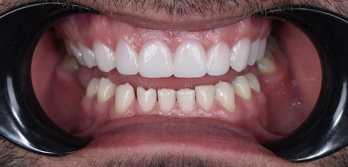 After treatment