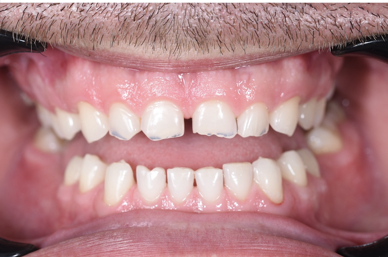 Before treatment