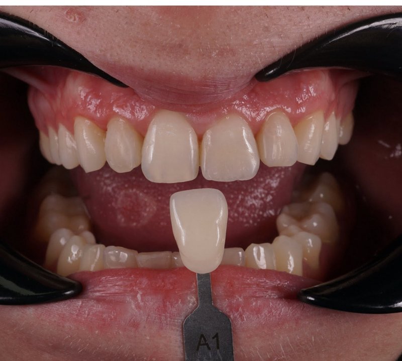 fatete dentare