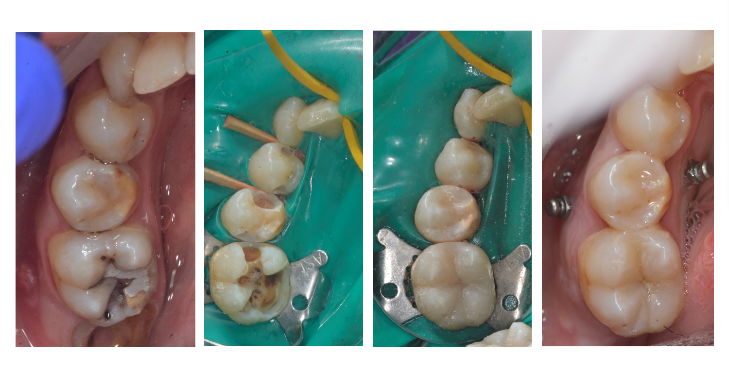 Tratamentul cariei dentare