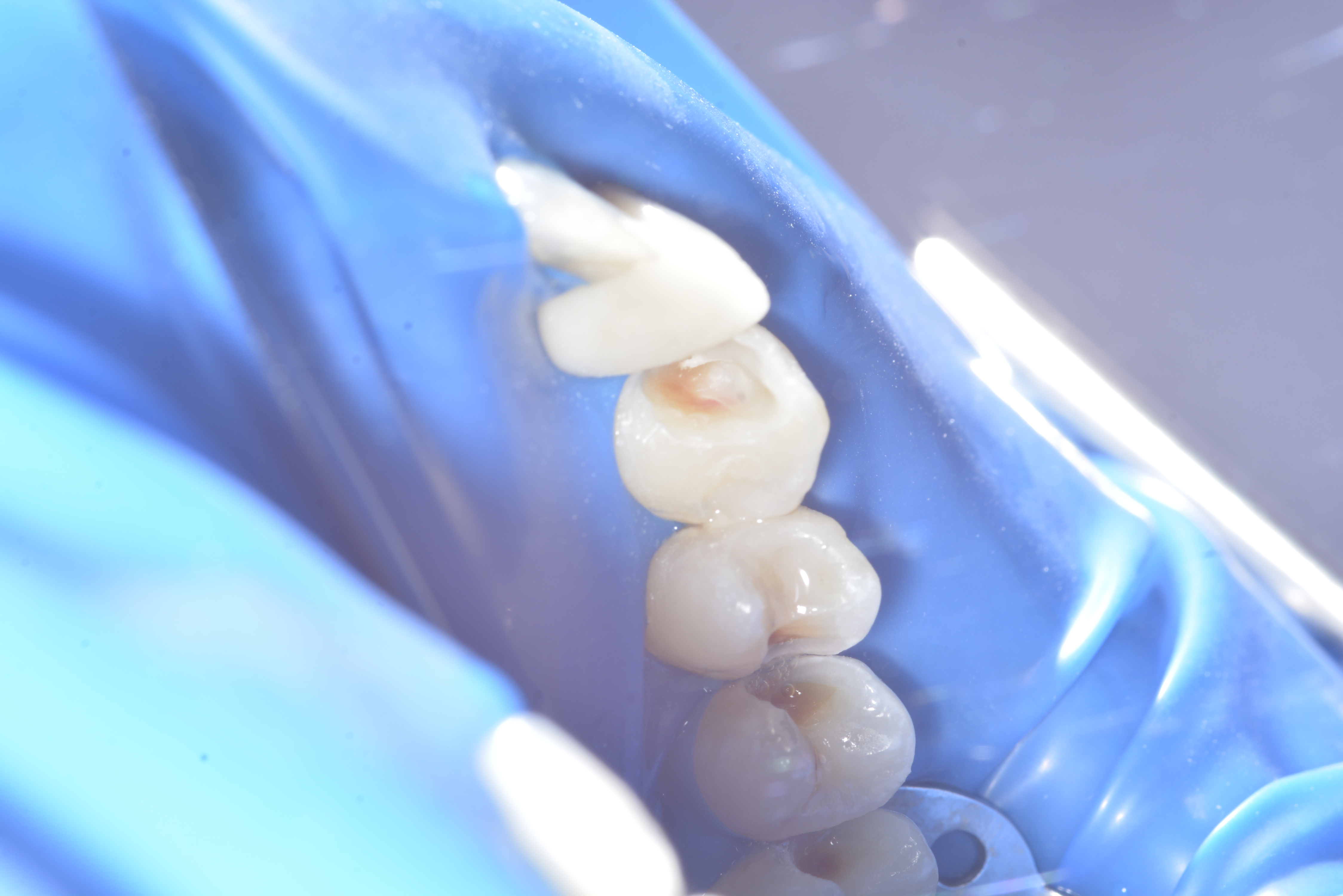 Tratamentul cariei dentare