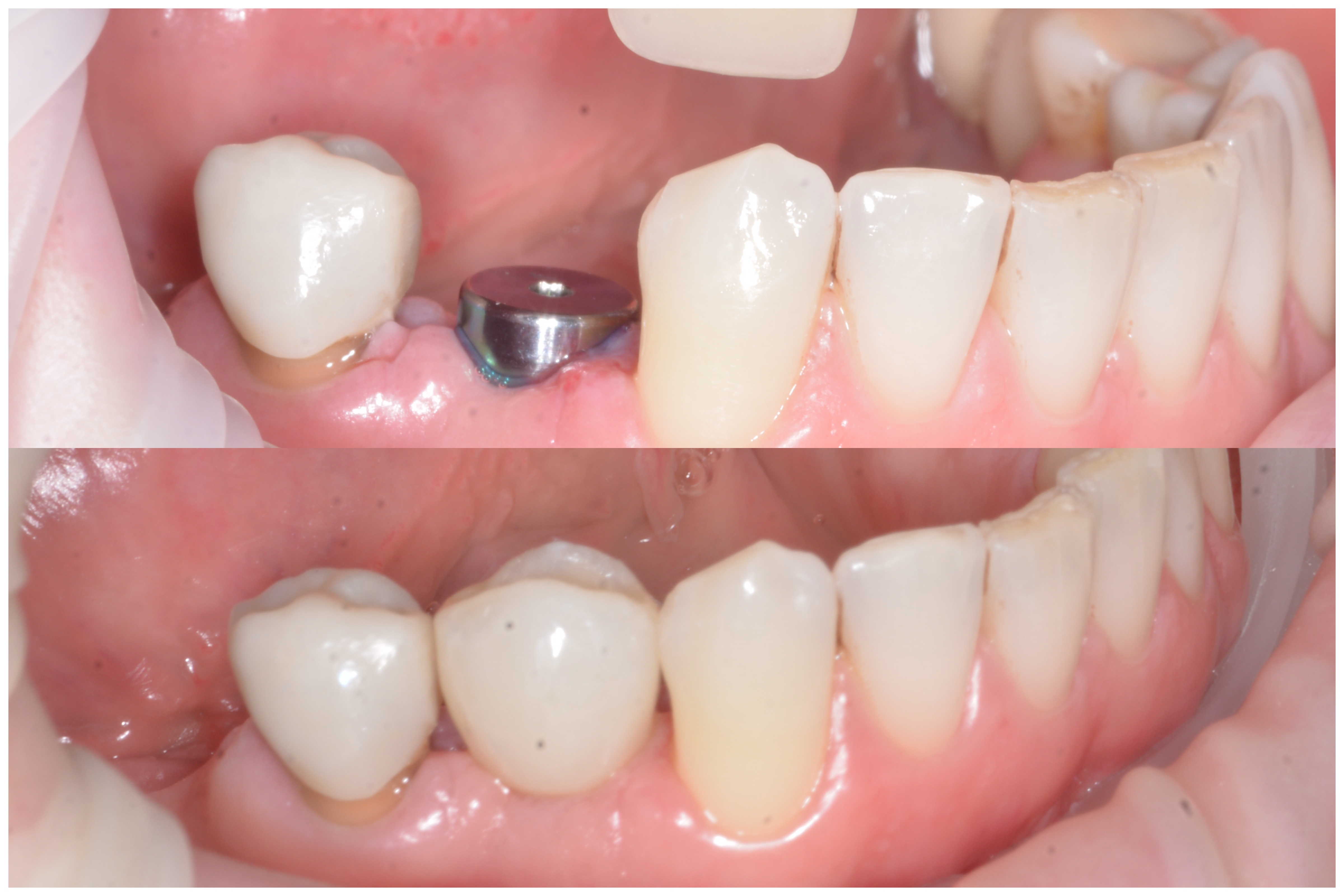 Implanturi dentare