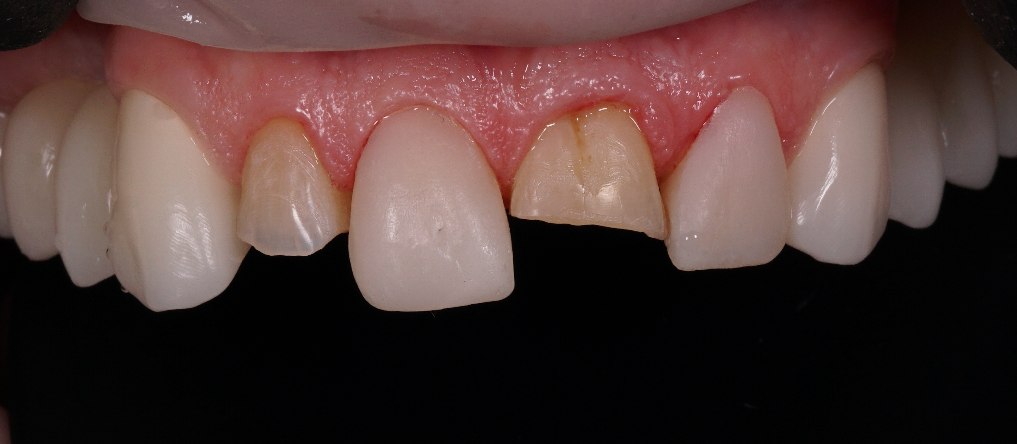 Uzura dentară