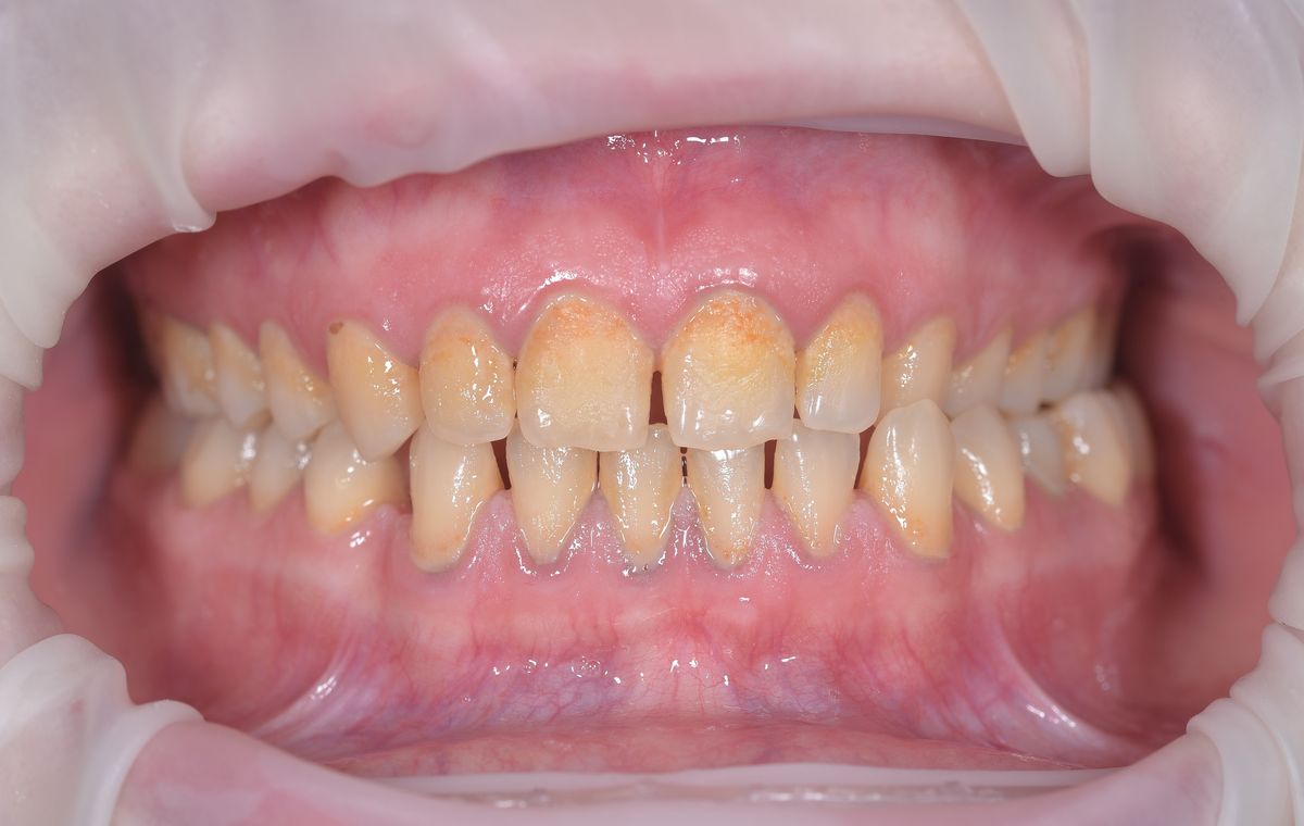 Prevenție dentară