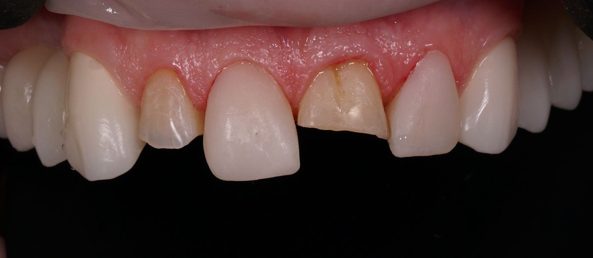 Uzura dentară