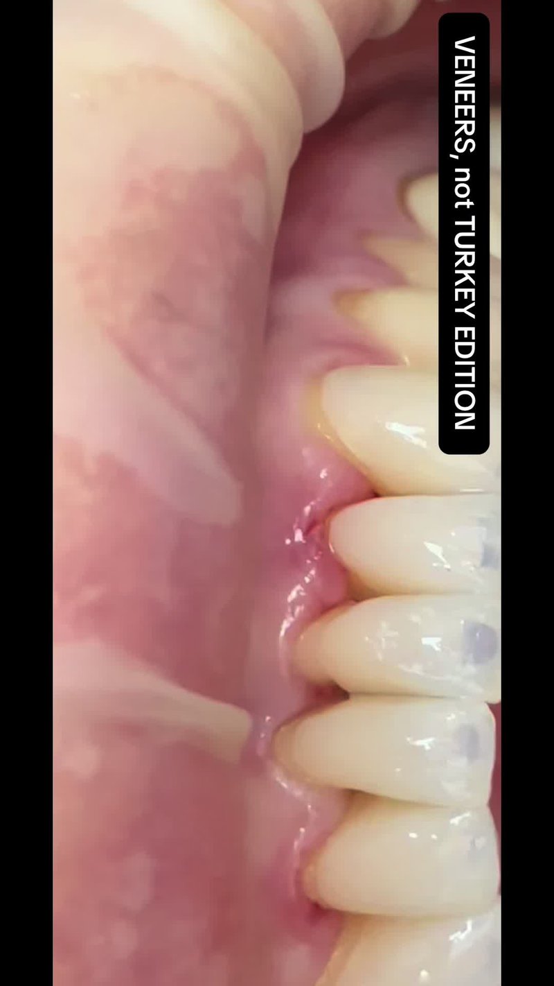 #veneers #turkeyteeth #romania #targumures 